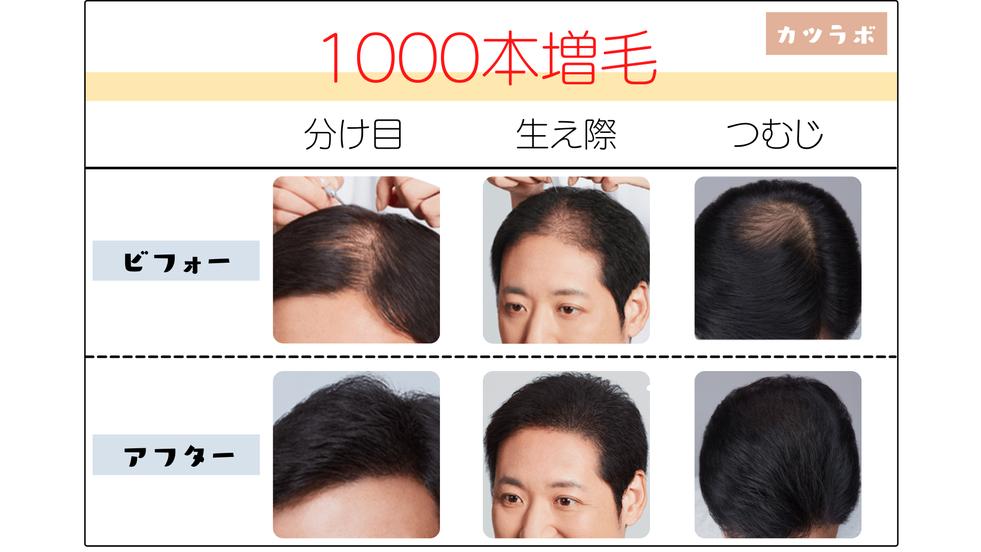 アートネイチャーの増毛1000本ってどのくらい増える ビフォーアフター画像付き カツラボ