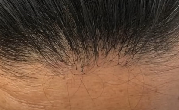 増毛はデメリットだらけでメリット無し 増毛のデメリットを暴露します カツラボ